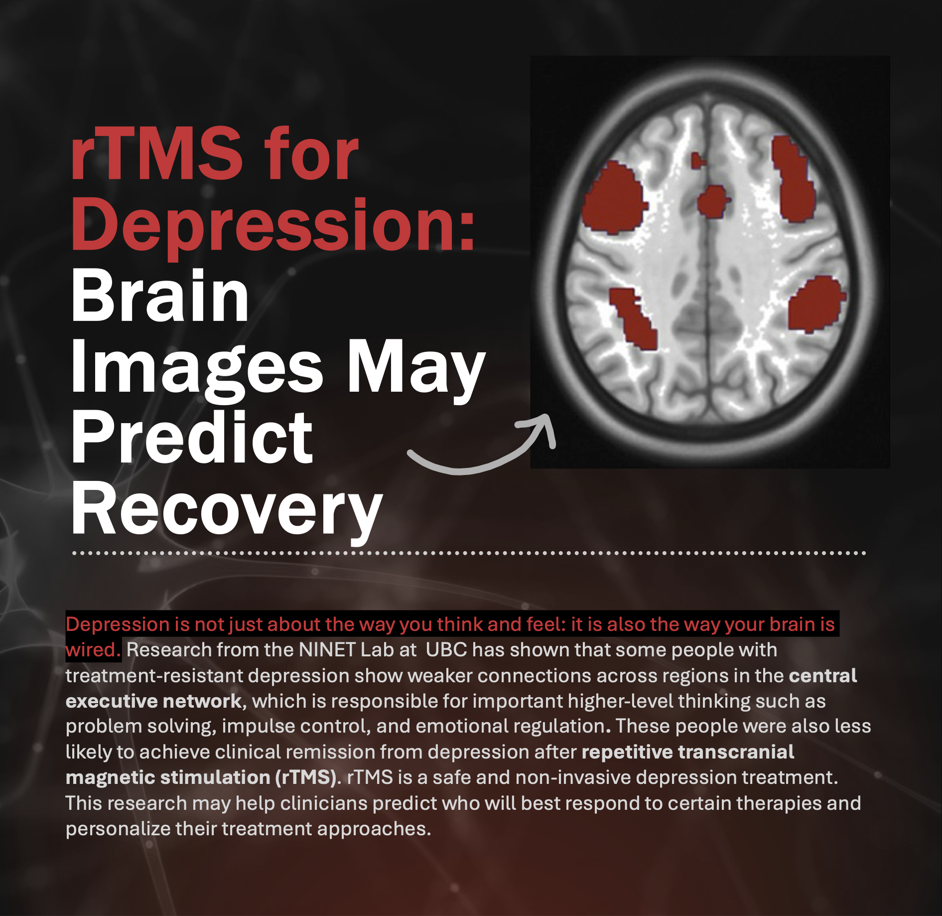 rTMS for Depression: Brain Images May Predict Recovery